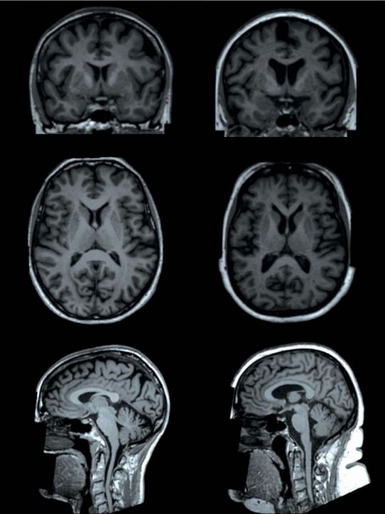 hersenen-veel-lichaamsvet-1556438713.jpg